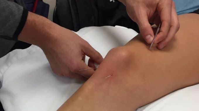 What Does It Feel Like To Have Acupuncture?
